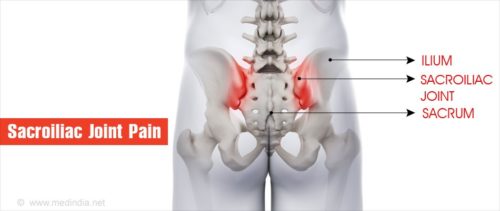 仙腸関節痛