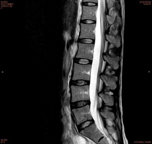 正常なMRI