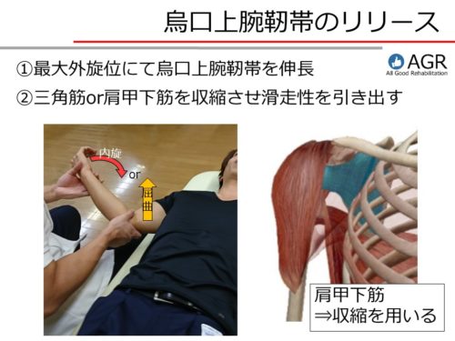 烏口上腕靭帯のリリース